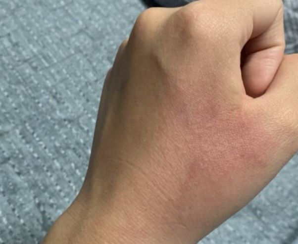 화상 입는 꿈의 상징적인 해석과 상황 별 해몽