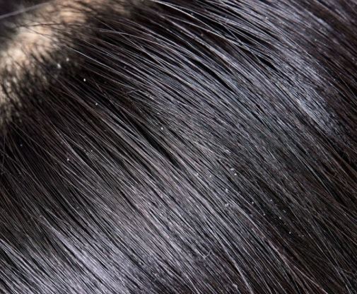 머리 비듬 꿈의 상징적인 해석과 상황 별 해몽