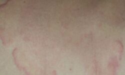 두드러기 나는 꿈 해몽의 의미