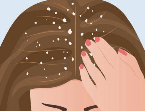 머리 비듬 꿈의 의미