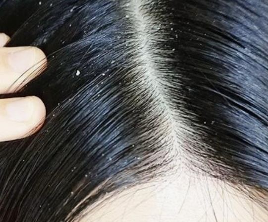 비듬 많은 꿈의 의미