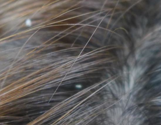 머리에 이가 있는 꿈의 의미