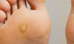 티눈 빠지는 꿈의 의미(해몽) 티눈 빠지는 꿈의 의미