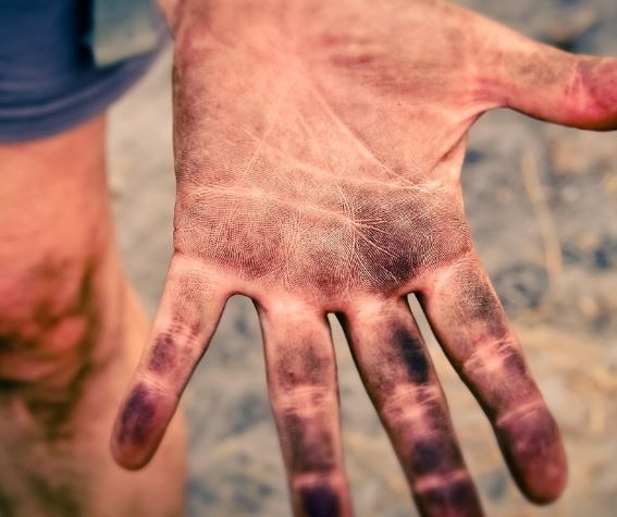 손 다치는 꿈의 의미(태몽, 재물, 운세)