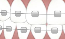 교정기 꿈의 의미