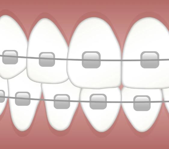 교정기 꿈의 의미