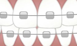 교정기를 착용하는 꿈의 의미