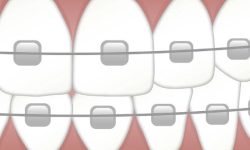 교정기를 빼는 꿈의 의미