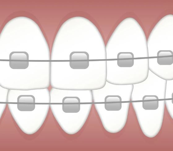 교정기를 빼는 꿈의 의미