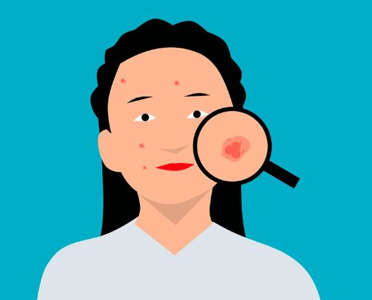 얼굴에 여드름 나는 꿈의 의미